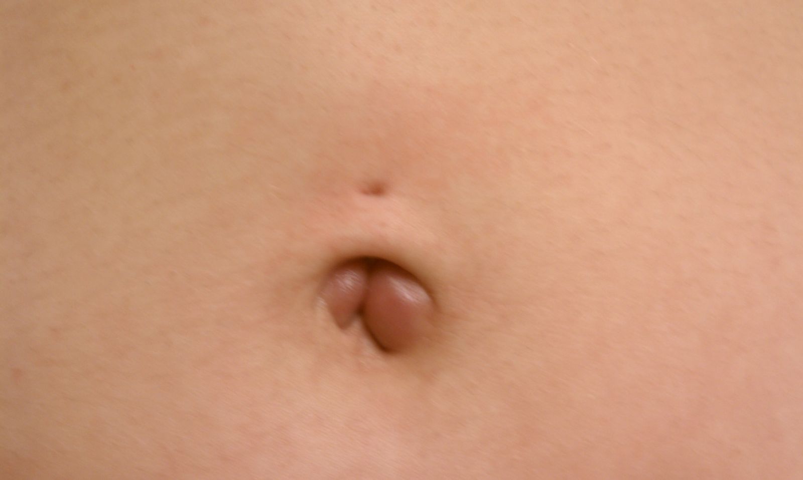 Erythematous nodules -Dermatology-Dermatology-HealthFrom.com